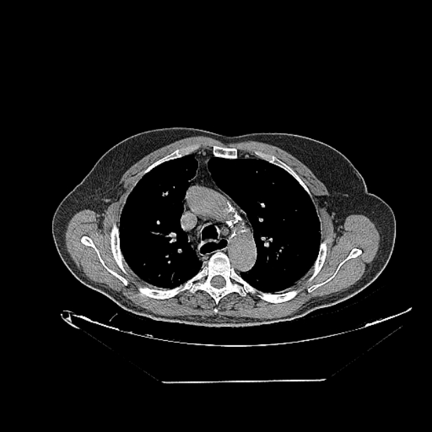 Cavitating bronchogenic carcinoma (Radiopaedia 44489-48162 Axial non-contrast 26).jpg