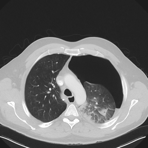 File:Cavitating pneumonia complicated by pneumothorax (Radiopaedia 48149-52994 Axial lung window 21).png