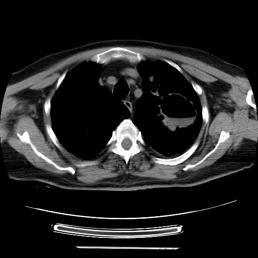 Cavitating pulmonary metastases (Radiopaedia 89545-106544 Axial non-contrast 12).jpg