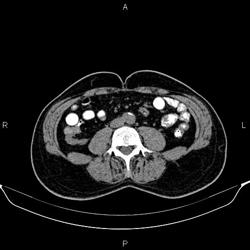 Cecal adenocarcinoma (Radiopaedia 85324-100916 Axial non-contrast 56).jpg