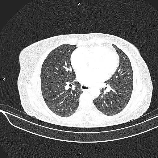 Cecal cancer (Radiopaedia 85610-101358 Axial lung window 38).jpg