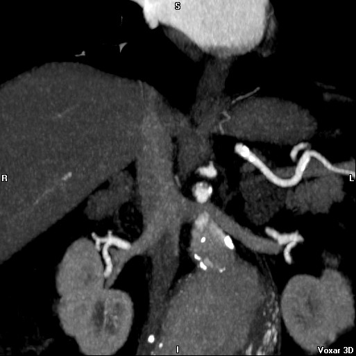 File:Celiac artery anatomy (Radiopaedia 16763-16476 A 12).jpg