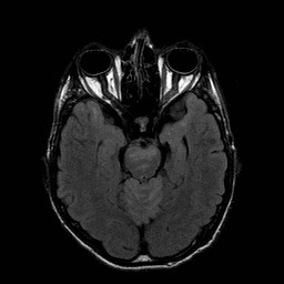 File:Central-variant posterior reversible encephalopathy syndrome (PRES) (Radiopaedia 43880-47358 Axial FLAIR 8).jpg