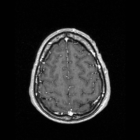 File:Central-variant posterior reversible encephalopathy syndrome (PRES) (Radiopaedia 43880-47358 Axial T1 C+ 141).jpg