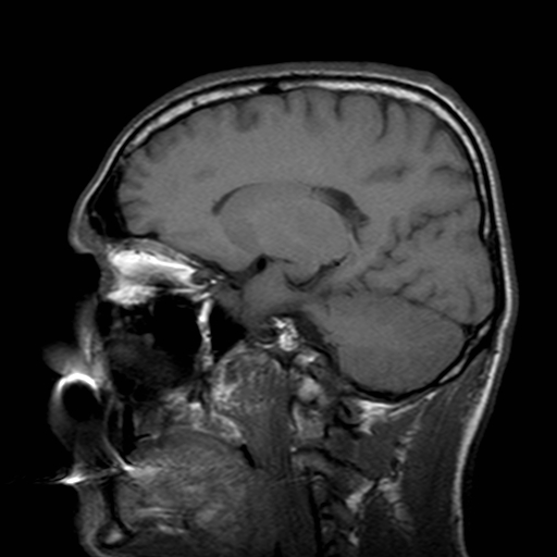 File:Central-variant posterior reversible encephalopathy syndrome (PRES) (Radiopaedia 43880-47358 Sagittal T1 15).jpg