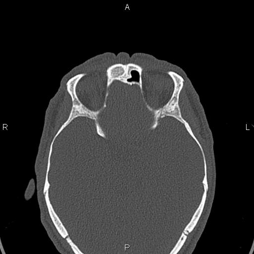 File:Central giant cell granuloma (Radiopaedia 83346-97761 Axial bone window 67).jpg