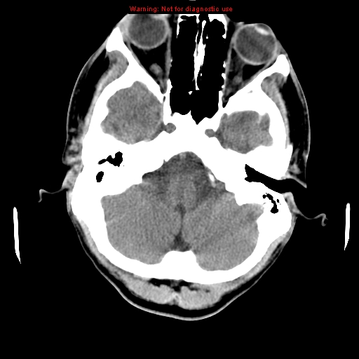 File:Central nervous system vasculitis (Radiopaedia 8410-9234 Axial non-contrast 29).jpg
