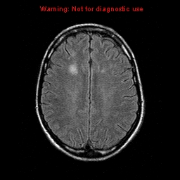 File:Central nervous system vasculitis (Radiopaedia 8410-9235 Axial FLAIR 17).jpg