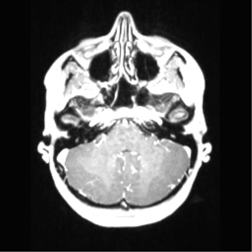 File:Central neurocytoma (Radiopaedia 37664-39557 Axial T1 C+ 20).png