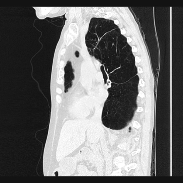 Centrilobular pulmonary emphysema (Radiopaedia 24495-24789 Sagittal lung window 37).jpg