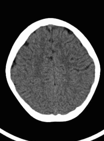 Cerebellar abscess (Radiopaedia 73727-84527 Axial non-contrast 51).jpg