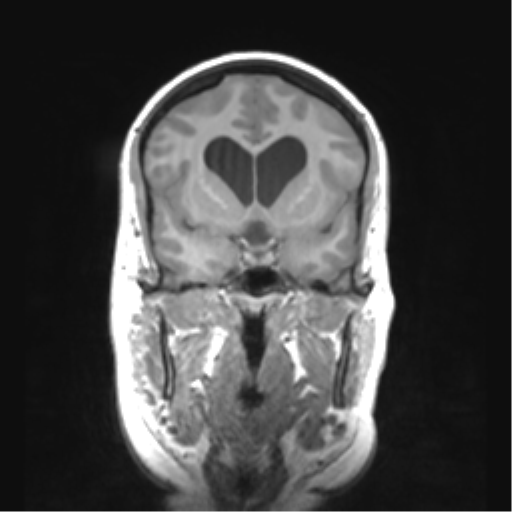 Cerebellar ependymoma complicated by post-operative subdural hematoma (Radiopaedia 83322-97736 Coronal T1 21).png