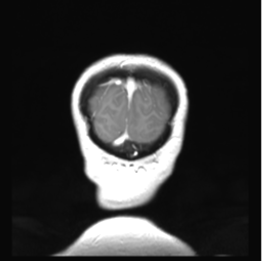 Cerebellar ependymoma complicated by post-operative subdural hematoma (Radiopaedia 83322-97736 Coronal T1 C+ 55).png