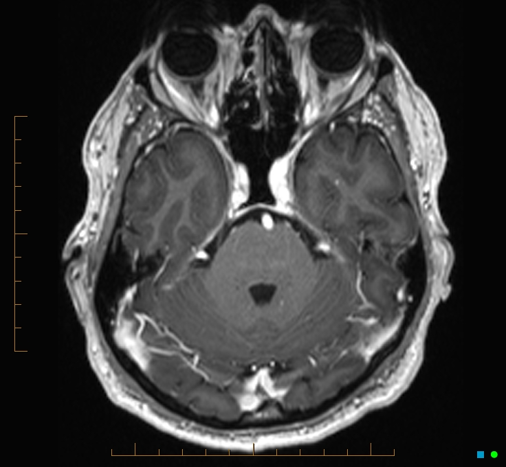 Cerebellar gangliocytoma (Radiopaedia 65377-74422 Axial T1 C+ 34).jpg