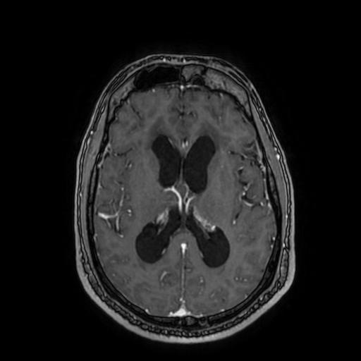 Cerebellar hemangioblastoma (Radiopaedia 88055-104622 Axial T1 C+ 102).jpg