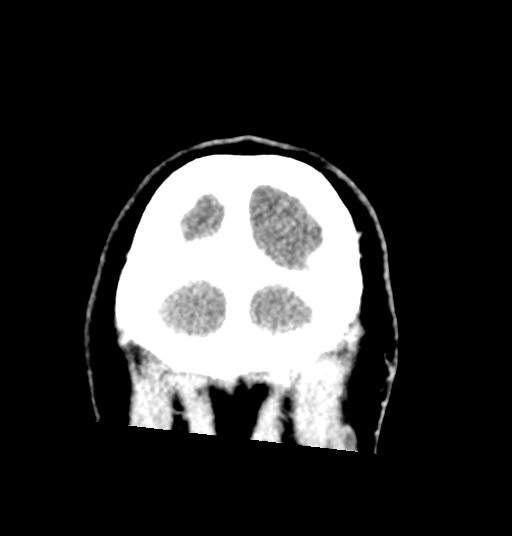 Cerebellar metastases - colorectal adenocarcinoma (Radiopaedia 40947-43652 Coronal C+ 85).png