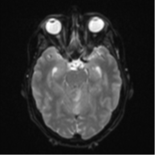 Cerebellar metastasis (Radiopaedia 51137-56765 Axial DWI 11).png