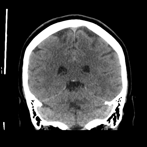 Cerebellar metastasis (cystic appearance) (Radiopaedia 41395-44258 Coronal non-contrast 41).png