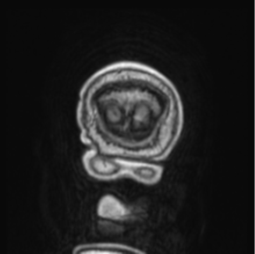 File:Cerebellar metastasis from lung adenocarcinoma (Radiopaedia 86690-102829 Coronal T1 C+ 2).png