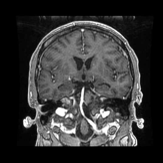 File:Cerebellar metastasis of pulmonary adenocarcinoma, cavernous venous malformation, and developmental venous anomaly (Radiopaedia 85827-101661 Coronal T1 C+ 57).jpg