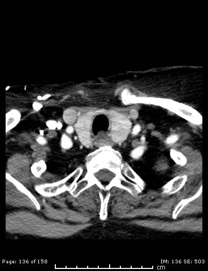 Cerebellar strokes due to intracranial giant cell arteritis (Radiopaedia 68799-78510 CT angiogram 136).jpg