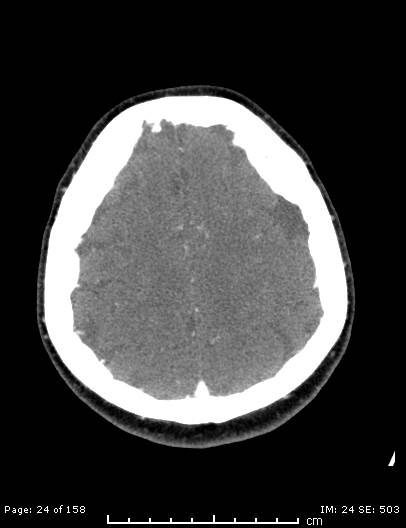 File:Cerebellar strokes due to intracranial giant cell arteritis (Radiopaedia 68799-78510 CT angiogram 24).jpg