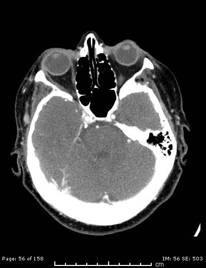 File:Cerebellar strokes due to intracranial giant cell arteritis (Radiopaedia 68799-78510 CT angiogram 56).jpg