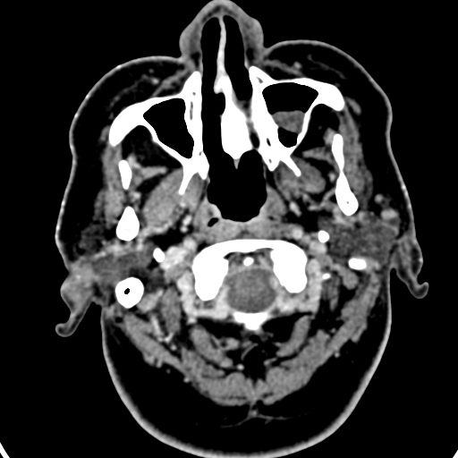 Cerebellopontine angle meningioma (Radiopaedia 35181-36714 A 62).jpg