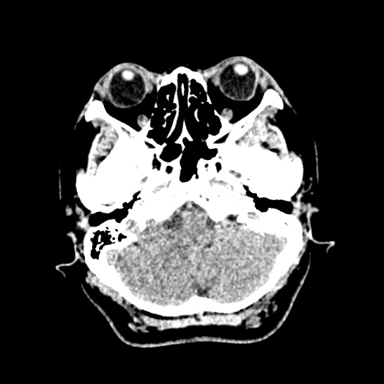 File:Cerebellopontine angle meningioma (Radiopaedia 53561-59592 Axial non-contrast 13).jpg