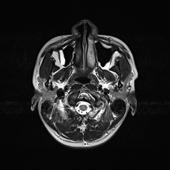 Cerebral abscess (Radiopaedia 24212-24478 Axial T2 9).jpg