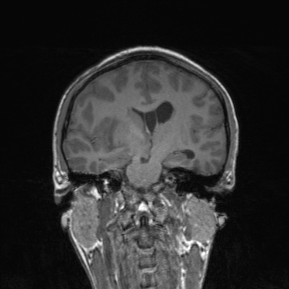 File:Cerebral abscess (Radiopaedia 24212-24478 Coronal T1 113).jpg