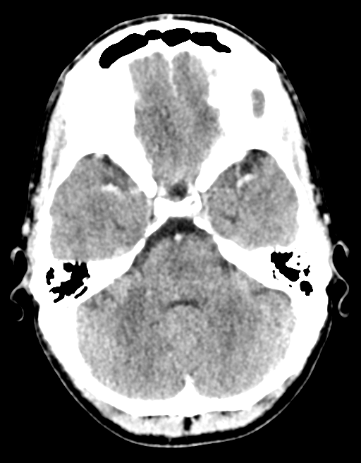 Cerebral abscess (Radiopaedia 60342-68008 Axial C+ delayed 15).png