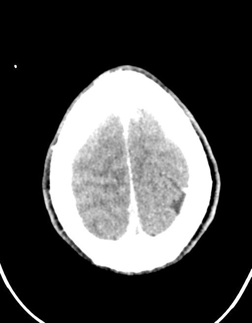 Cerebral abscess (Radiopaedia 60342-68008 Axial C+ delayed 45).png