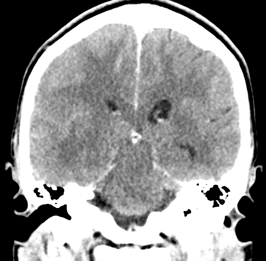 Cerebral abscess (Radiopaedia 60342-68008 Coronal C+ delayed 40).png