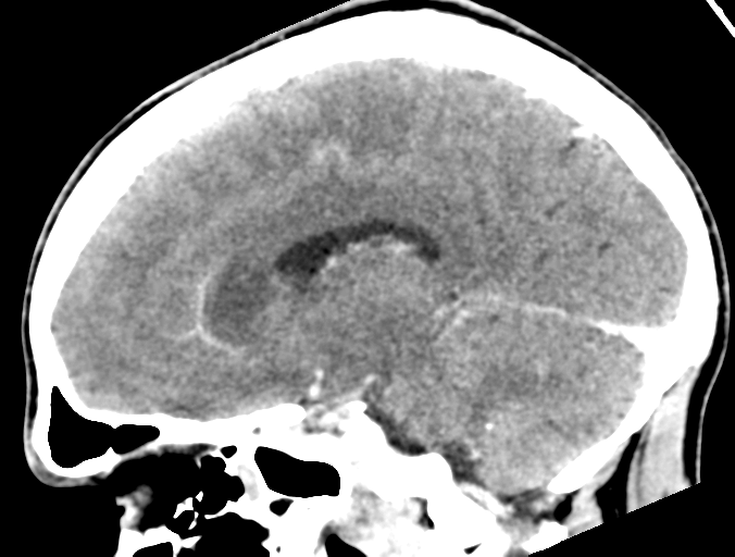 File:Cerebral abscess (Radiopaedia 60342-68008 Sagittal C+ delayed 22).png