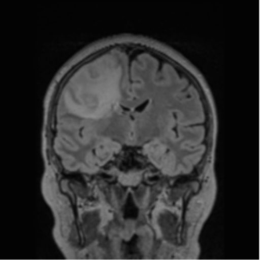 Cerebral abscess from pulmonary arteriovenous malformation (Radiopaedia 86275-102291 Coronal FLAIR 49).png