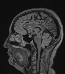 Cerebral abscess from pulmonary arteriovenous malformation (Radiopaedia 86275-102291 Sagittal FLAIR 37).png