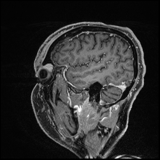 Cerebral abscess with ventriculitis (Radiopaedia 78965-91878 Sagittal T1 C+ 42).jpg