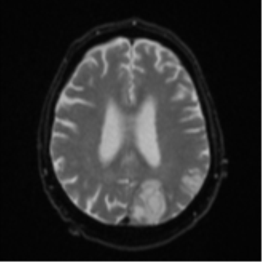 Cerebral abscesses- medically managed (Radiopaedia 45183-49179 Axial DWI 19).png