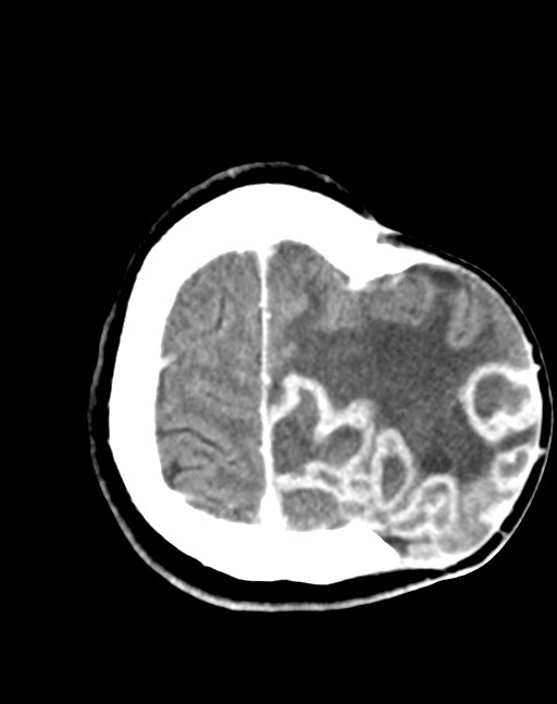 Cerebral abscesses (Radiopaedia 70458-80568 Axial Contrast 51).jpg