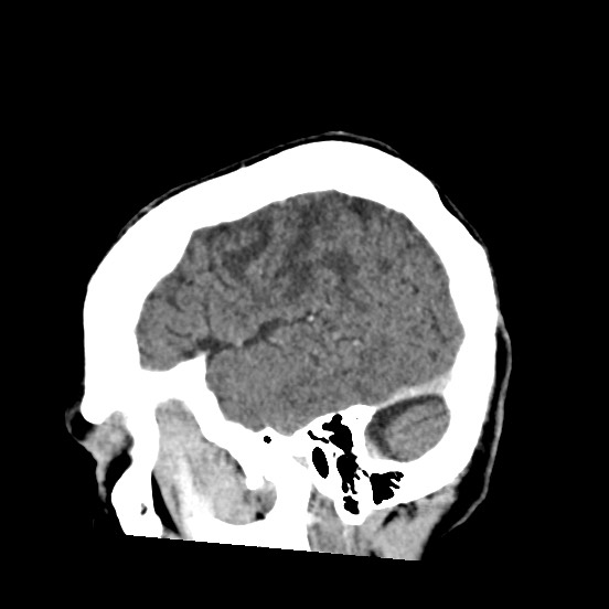 Cerebral amyloid angiopathy-related inflammation (Radiopaedia 74836-85848 C 12).jpg