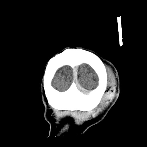 File:Cerebral amyloid angiopathy-related inflammation (Radiopaedia 74836-85848 Coronal non-contrast 68).jpg