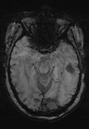 File:Cerebral amyloid angiopathy (Radiopaedia 29129-29518 Axial SWI MPR 13).jpg