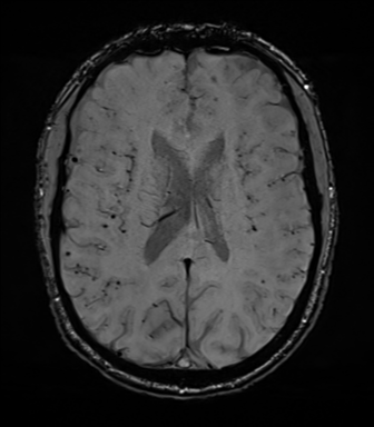 File:Cerebral amyloid angiopathy (Radiopaedia 46082-50433 Axial SWI 50).png