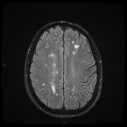 File:Cerebral amyloid angiopathy (Radiopaedia 77506-89664 Axial FLAIR 20).jpg