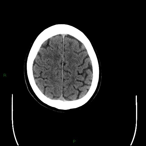 Cerebral amyloid angiopathy (Radiopaedia 77506-89665 Axial non-contrast 90).jpg