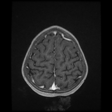 Cerebral and spinal tuberculosis (Radiopaedia 90489-107837 Axial T1 C+ 162).jpg