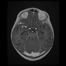 Cerebral and spinal tuberculosis (Radiopaedia 90489-107837 Axial T1 C+ 80).jpg