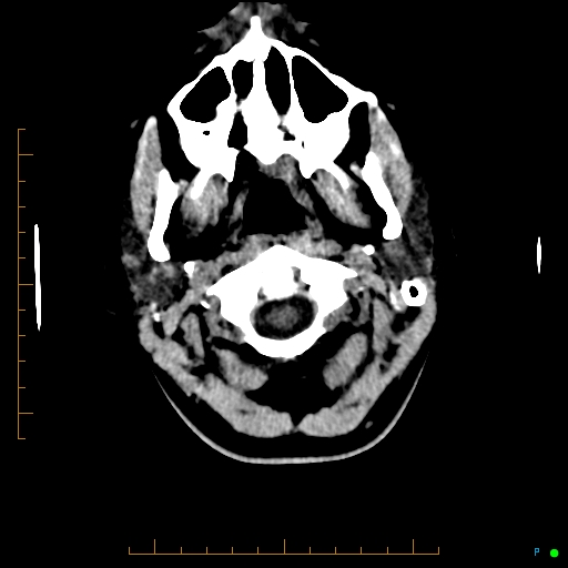 Cerebral arteriovenous malformation (AVM) (Radiopaedia 78162-90706 Axial non-contrast 5).jpg