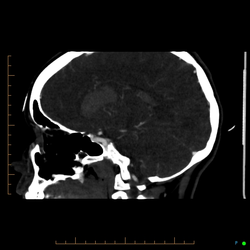 Cerebral arteriovenous malformation (AVM) (Radiopaedia 78162-90706 Sagittal CTA 35).jpg